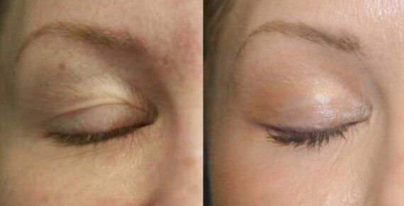 Care for areas near the eyes