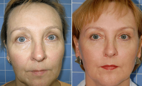 Before and after the rejuvenation procedure