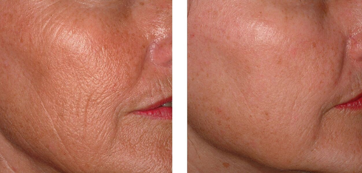 Rejuvenation of the skin