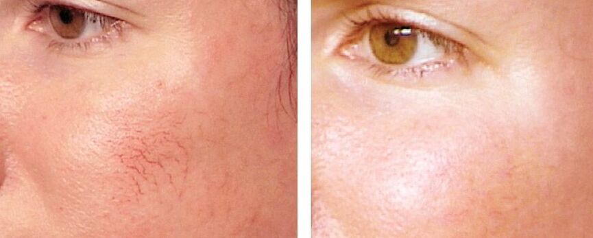 Distance from Rosacea
