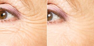Before and after fractional rejuvenation