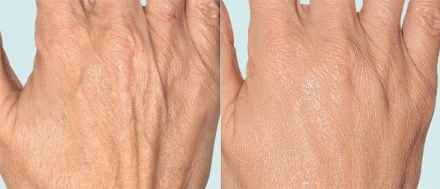 Hand skin before and after fractional therapy