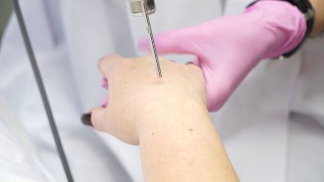 Laser hand skin rejuvenation
