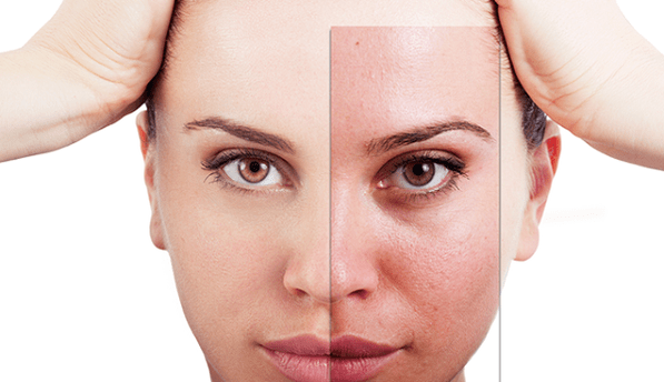Fractional rejuvenation eliminates the main aesthetic imperfections on the face